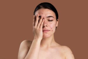 Acne & Acne Scar Treatment