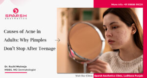 Causes of Acne in Adults Why Pimples Don’t Stop After Teenage final new1