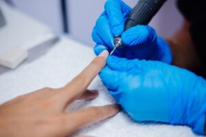 Laser Nail Avulsion