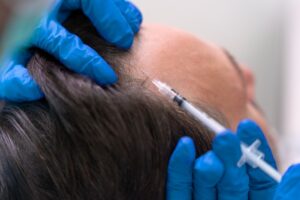 PRP Therapy for Hair Regrowth