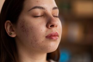 Pigmentation & Melasma Treatment