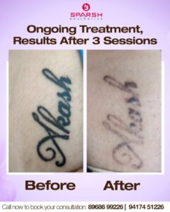 case before after sparsh