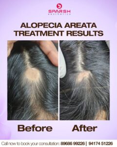case before after sparsh
