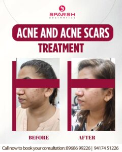 case before after Sparsh Aesthetics Clinic