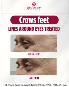 case before after Sparsh Aesthetics Clinic