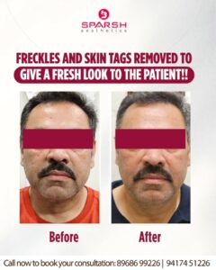 case before after Sparsh Aesthetics Clinic