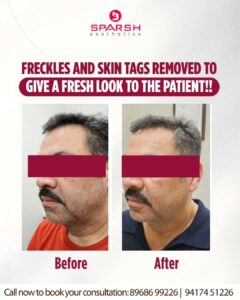 case before after Sparsh Aesthetics Clinic