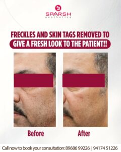 case before after Sparsh Aesthetics Clinic