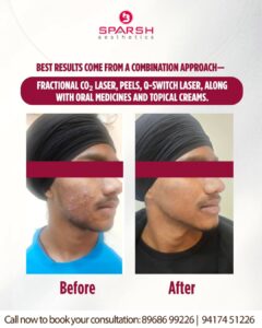 case before after Sparsh Aesthetics Clinic