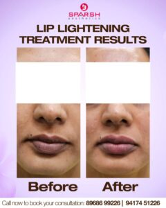 case before after sparsh
