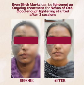 case before after Sparsh Aesthetics Clinic