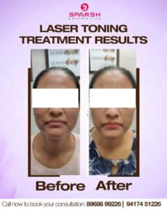 case before after sparsh