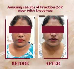 case before after Sparsh Aesthetics Clinic