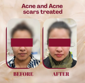 case before after Sparsh Aesthetics Clinic
