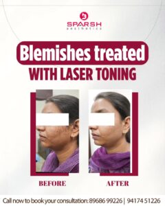 case before after Sparsh Aesthetics Clinic