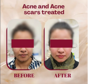 case before after Sparsh Aesthetics Clinic