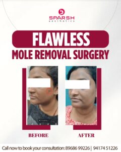 case before after Sparsh Aesthetics Clinic