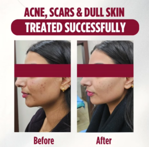 case before after Sparsh Aesthetics Clinic