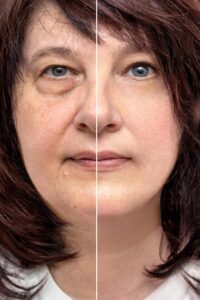 Anti Ageing Treatment