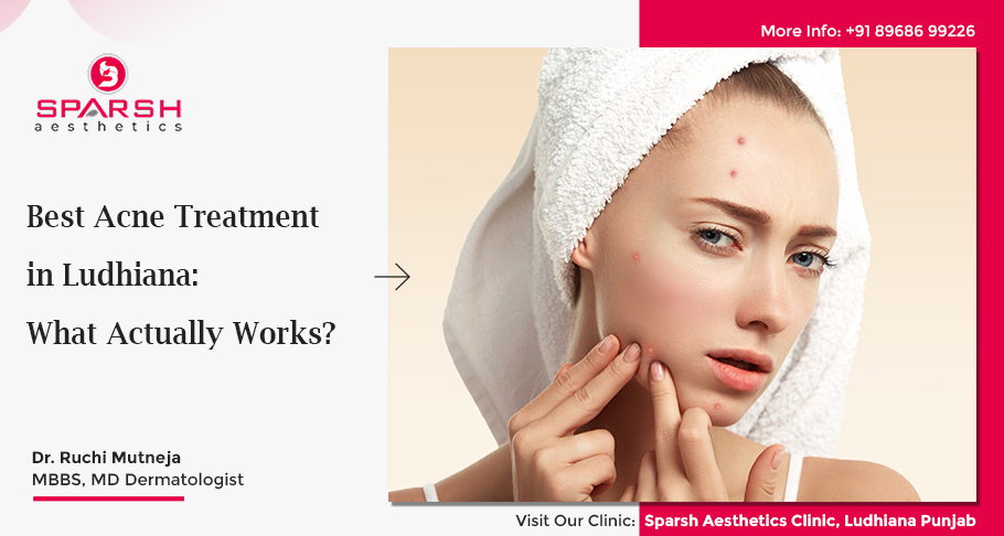 Best Acne Treatment in Ludhiana: What Actually Works?