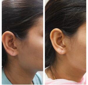 Earlobe Repair