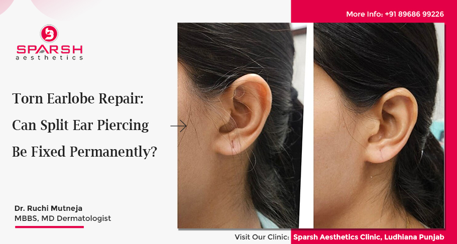 Torn Earlobe Repair: Can Split Ear Piercing Be Fixed Permanently?
