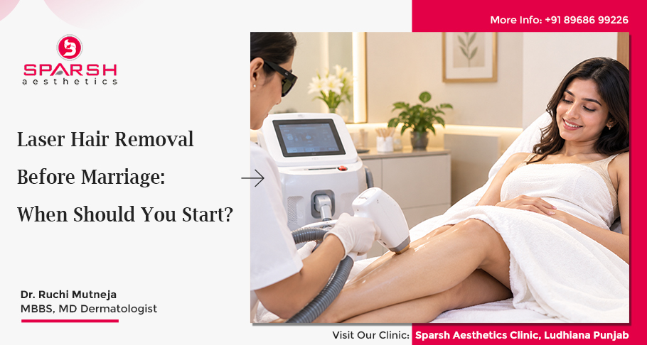Laser Hair Removal Before Marriage: When Should You Start?